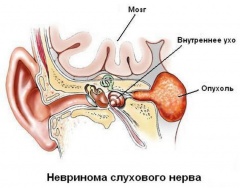 Невринома слухового нерва - причины, симптомы, лечение и профилактика